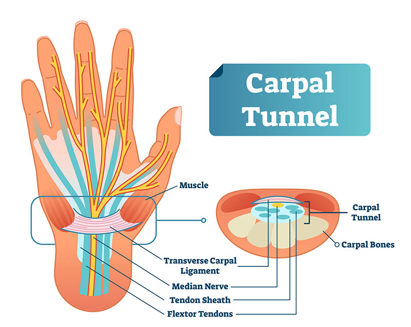 work restrictions for carpal tunnel syndrome.